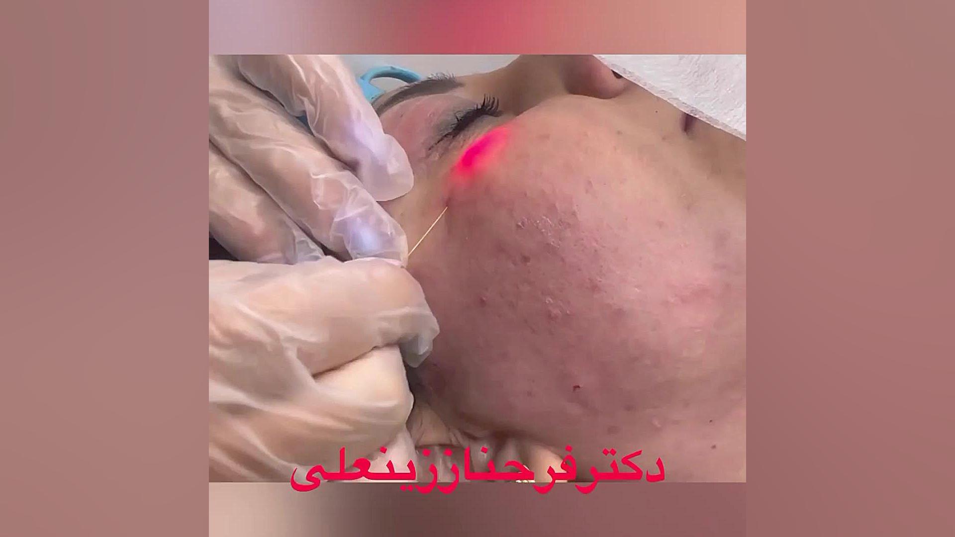 درمان چروک و پیری زیرچشم با لیزر اندولیفت با ماندگاری طولانی دکتر فرحناز زینعلی - متخصص پوست، مو، زیبایی زنجان