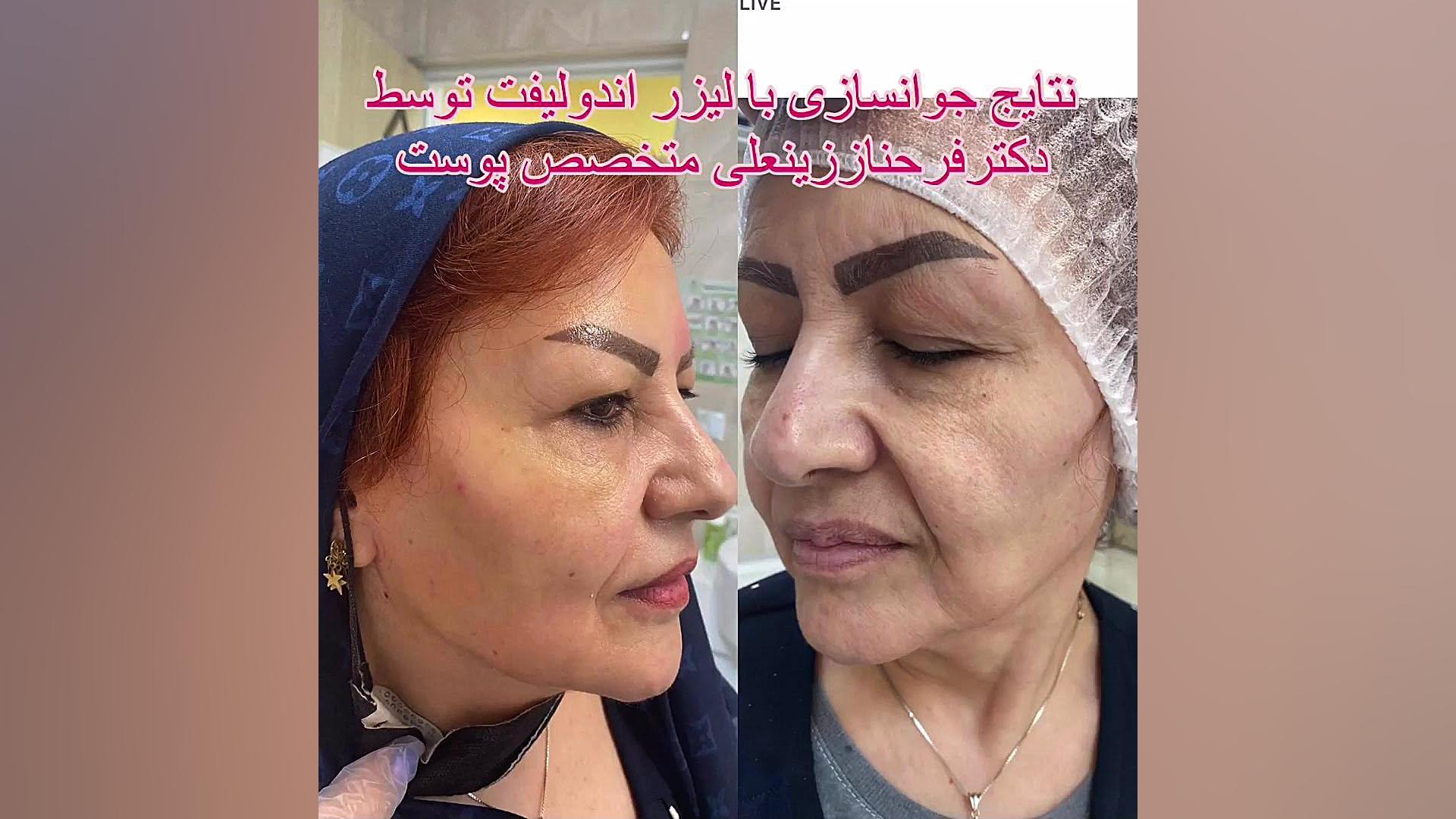 چند نمونه از هزاران نتایج لیزر پرقدرت اندولیفت قویترین لیزر جوانساز دکتر فرحناز زینعلی - متخصص پوست، مو، زیبایی زنجان