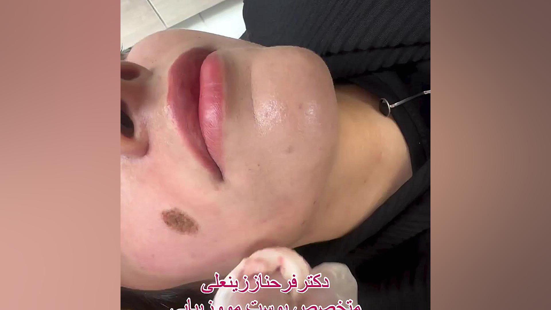 درمان و رفع دائمی انواع خالها با لیزر پیشرفته دکتر فرحناز زینعلی - متخصص پوست، مو، زیبایی زنجان