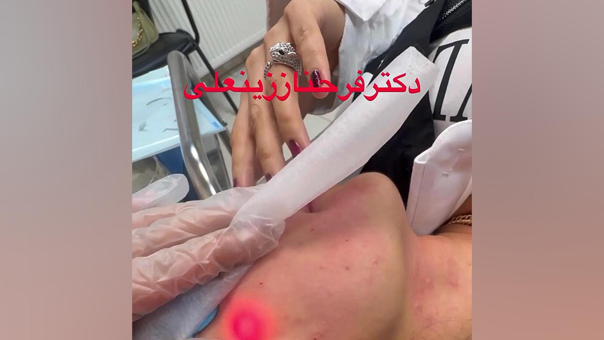 نتیجه عالی لیزر پرقدرت اندولیفت قویترین لیزر جوانساز دکتر فرحناز زینعلی - متخصص پوست، مو، زیبایی زنجان