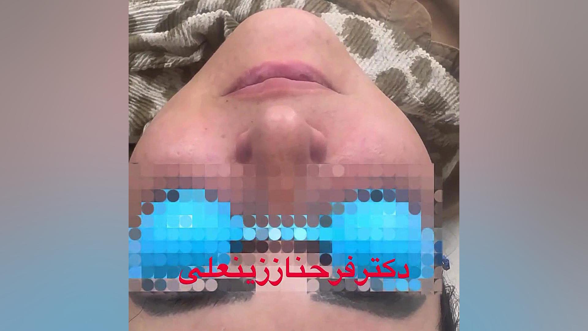 نتیجه تزریق چربی به گونه ها بعد از چهارسال دکتر فرحناز زینعلی - متخصص پوست، مو، زیبایی زنجان
