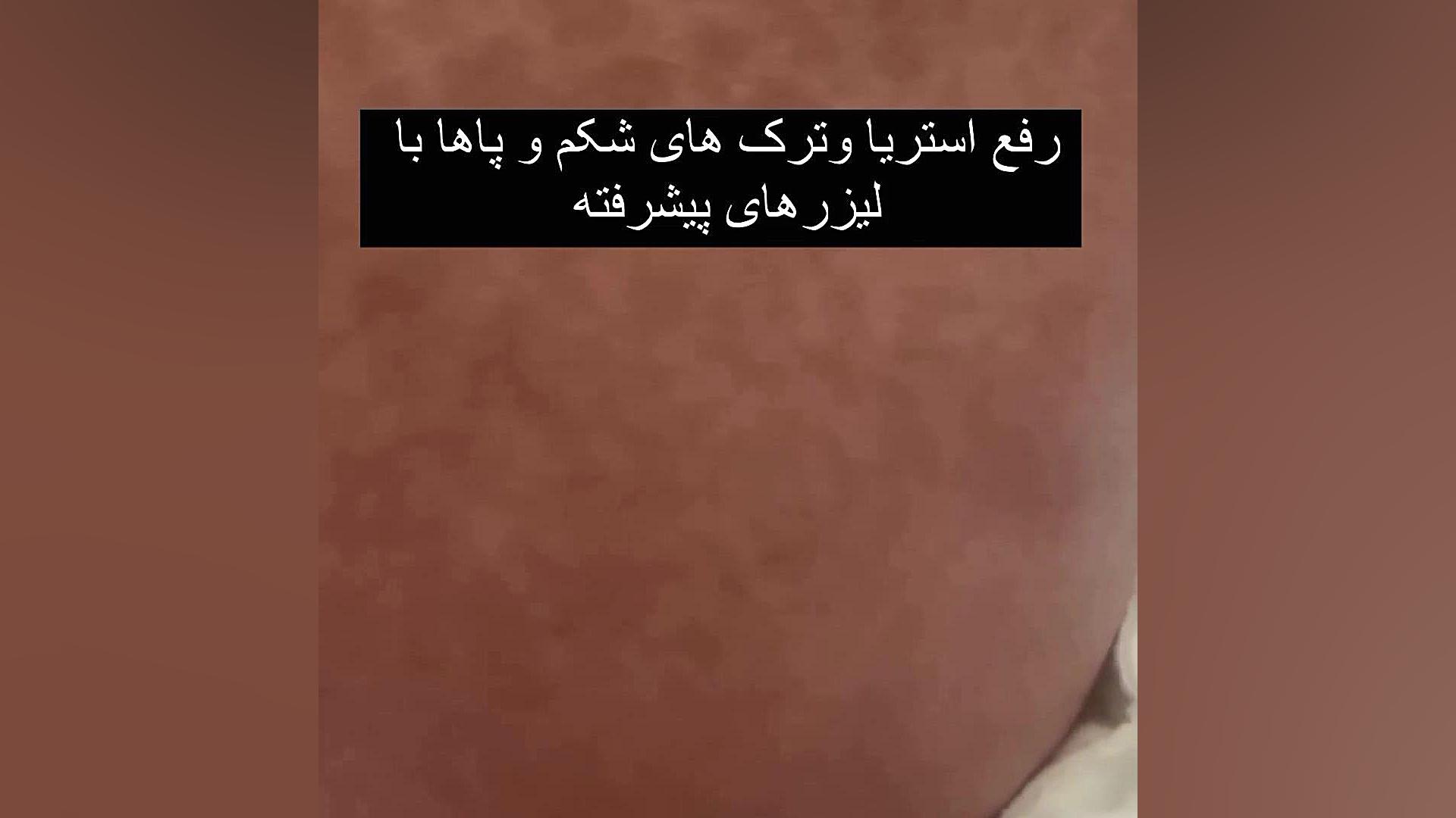 رفع استریا و ترک های شکم و پاها دکتر فرحناز زینعلی - متخصص پوست، مو، زیبایی زنجان