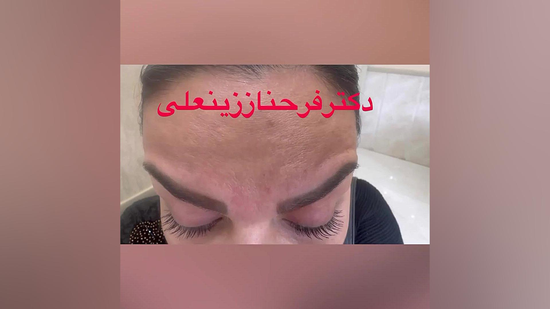 درمان چروکهای دینامیک و استاتیک صورت با تزریق بوتاکس دکتر فرحناز زینعلی - متخصص پوست، مو، زیبایی زنجان