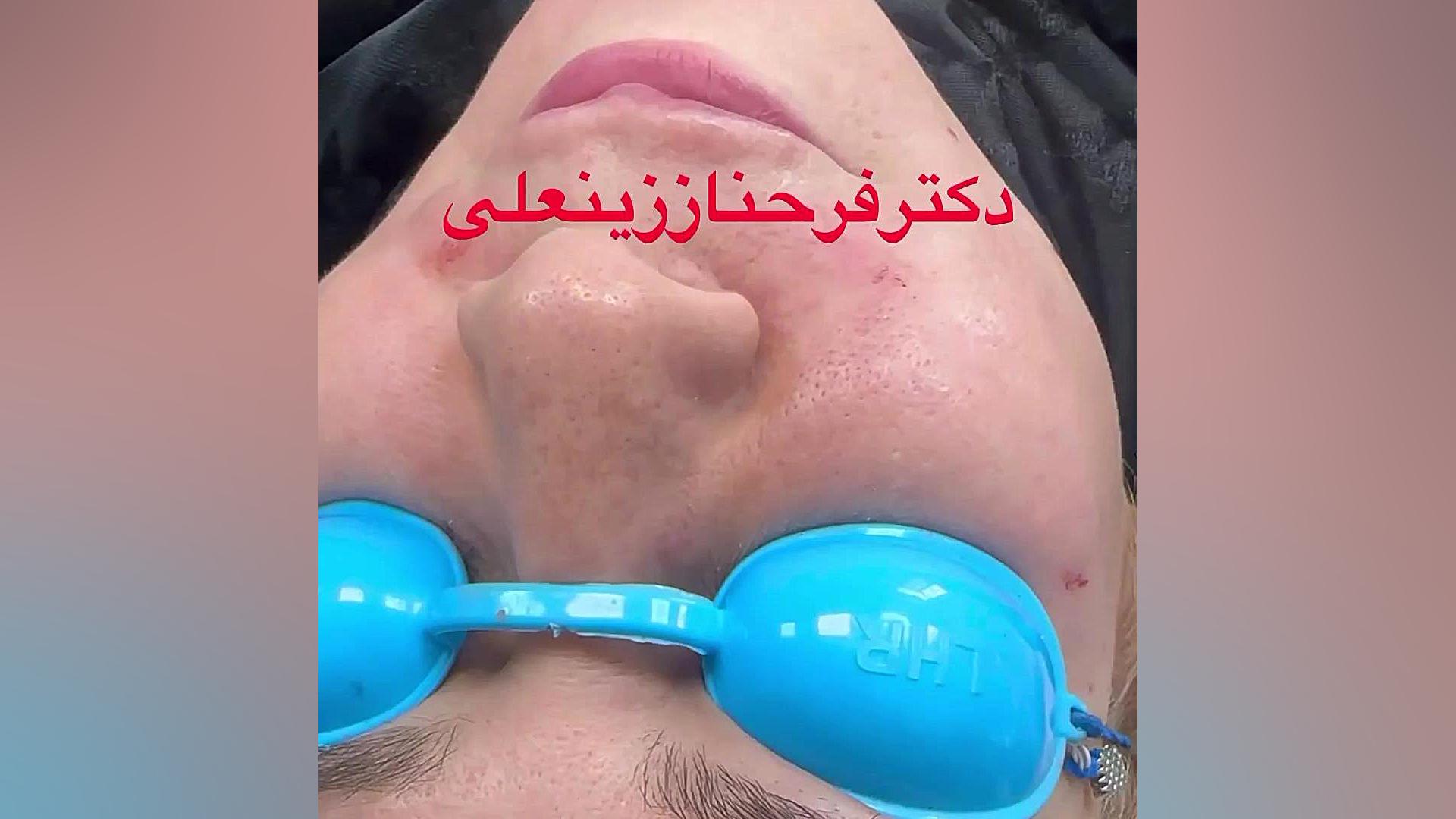 نتیجه بعد از سه سال از تزریق چربی به گونه ها و خط خنده دکتر فرحناز زینعلی - متخصص پوست، مو، زیبایی زنجان