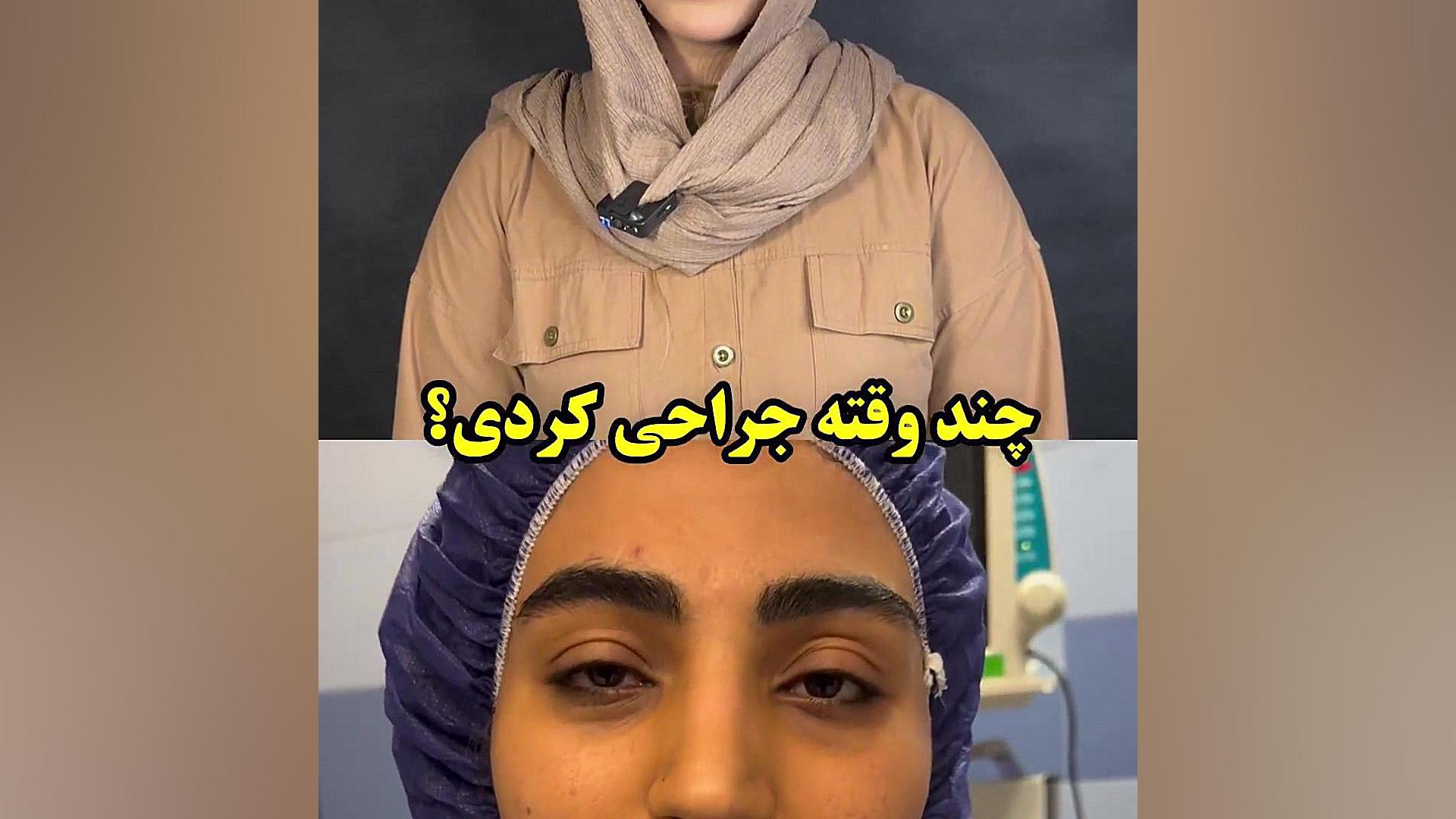 تغییرات بعد فقط 28 روز بعد جراحی بینی دکتر علی شفیعی رونیزی | بهترین جراح بینی تهران