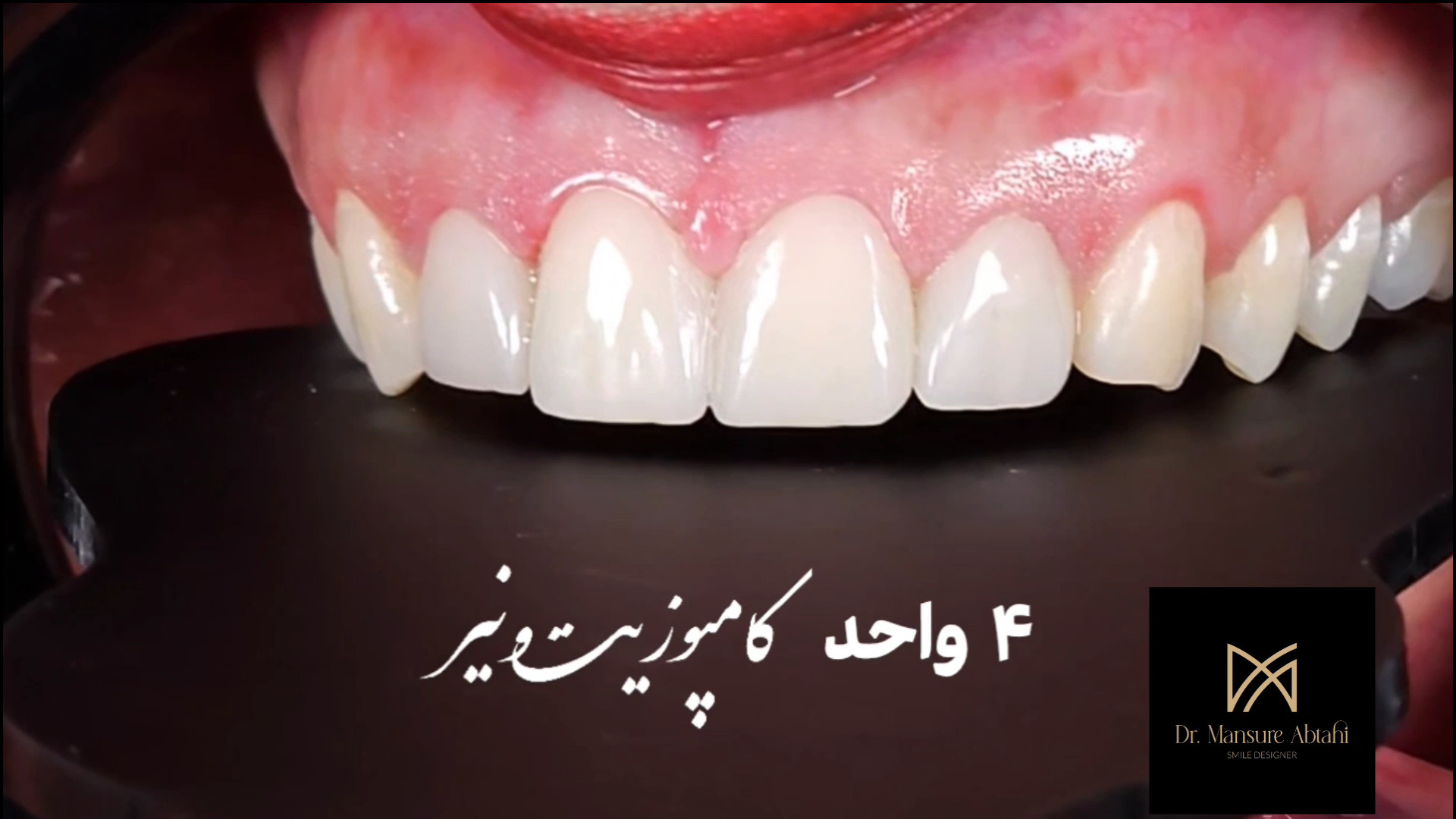 یک تغییر بزرگ تنها با چهار واحد کامپوزیت ونیر| دکتر منصوره ابطحی لیزر مو