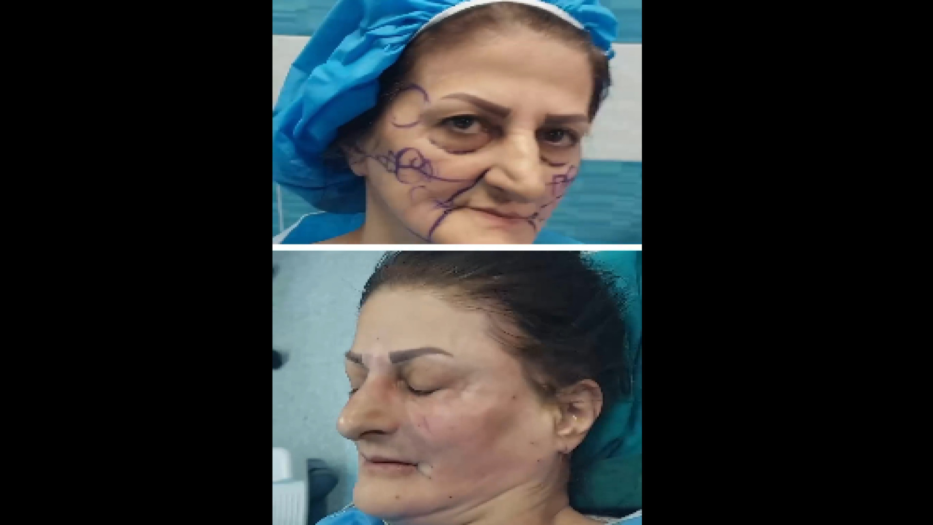 نمونه کار تزریق چربی به صورت دکتر هاتف زیرک زاده - فوق تخصص جراحی پلاستیک