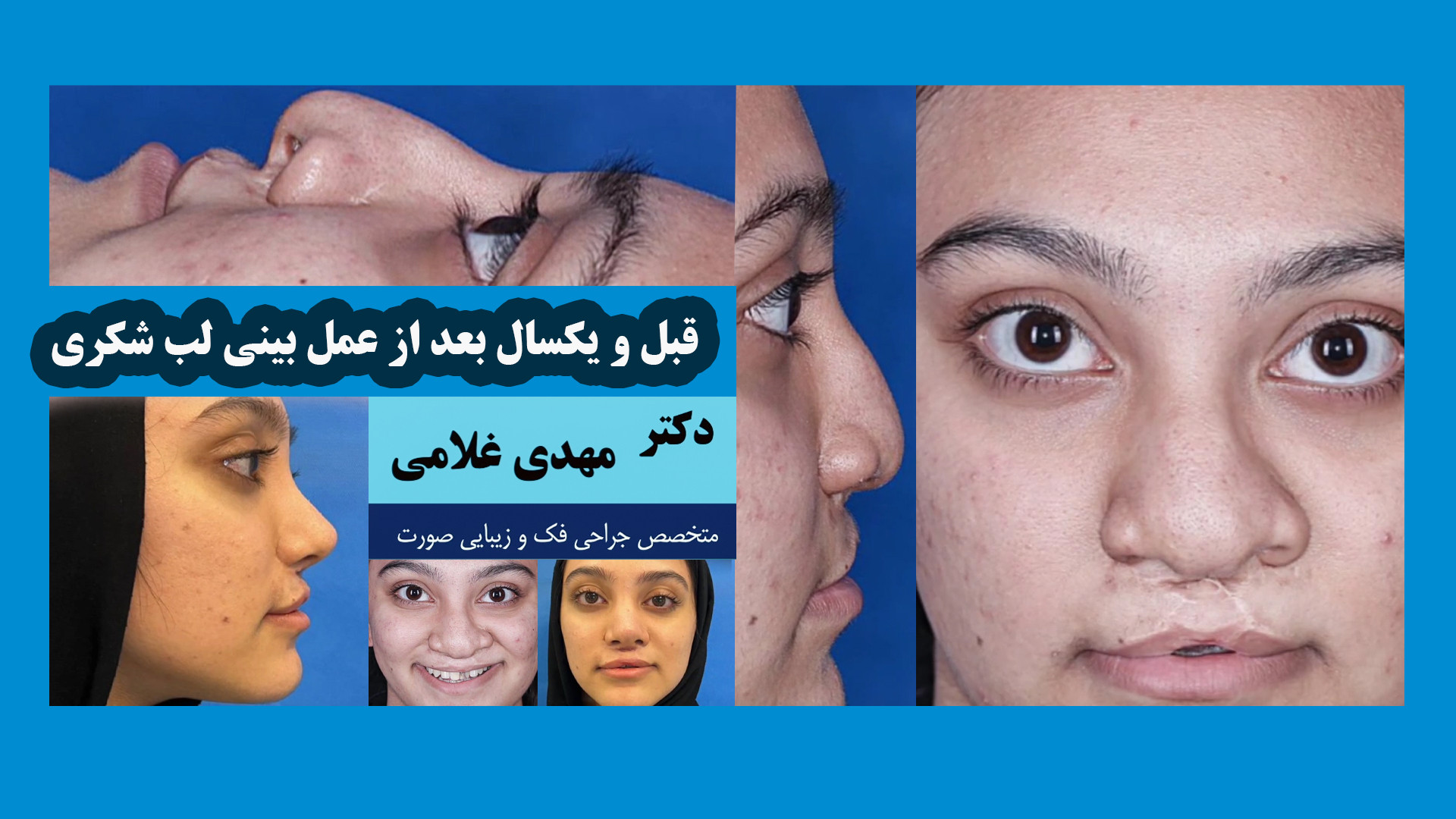 یکسال بعد از عمل بینی لب شکری توسط دکتر مهدی غلامی در مشهد دکتر مهدی غلامی