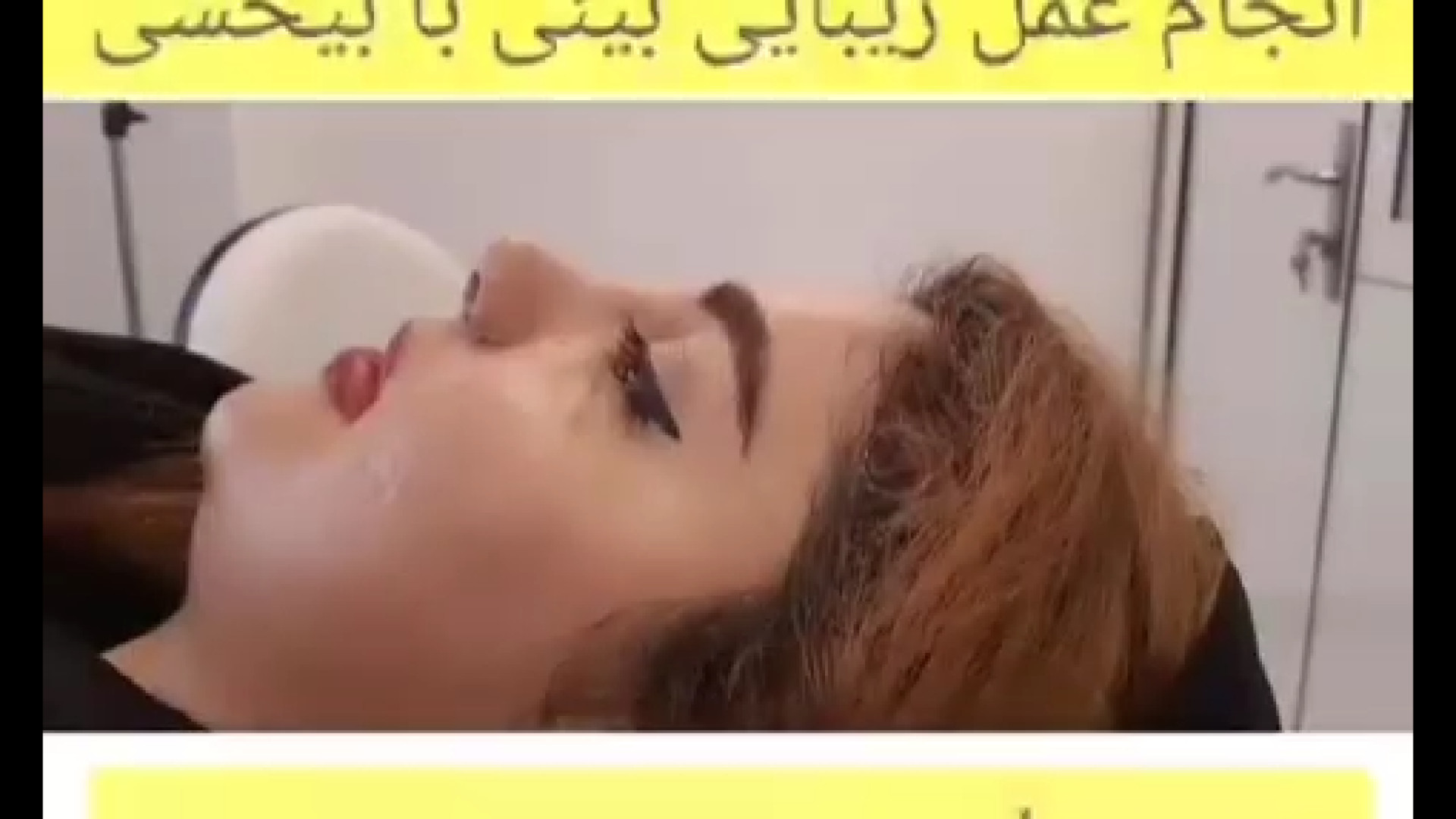 رینوپلاستی با بیحسی | دکتر لاجوردی جراحی لثه