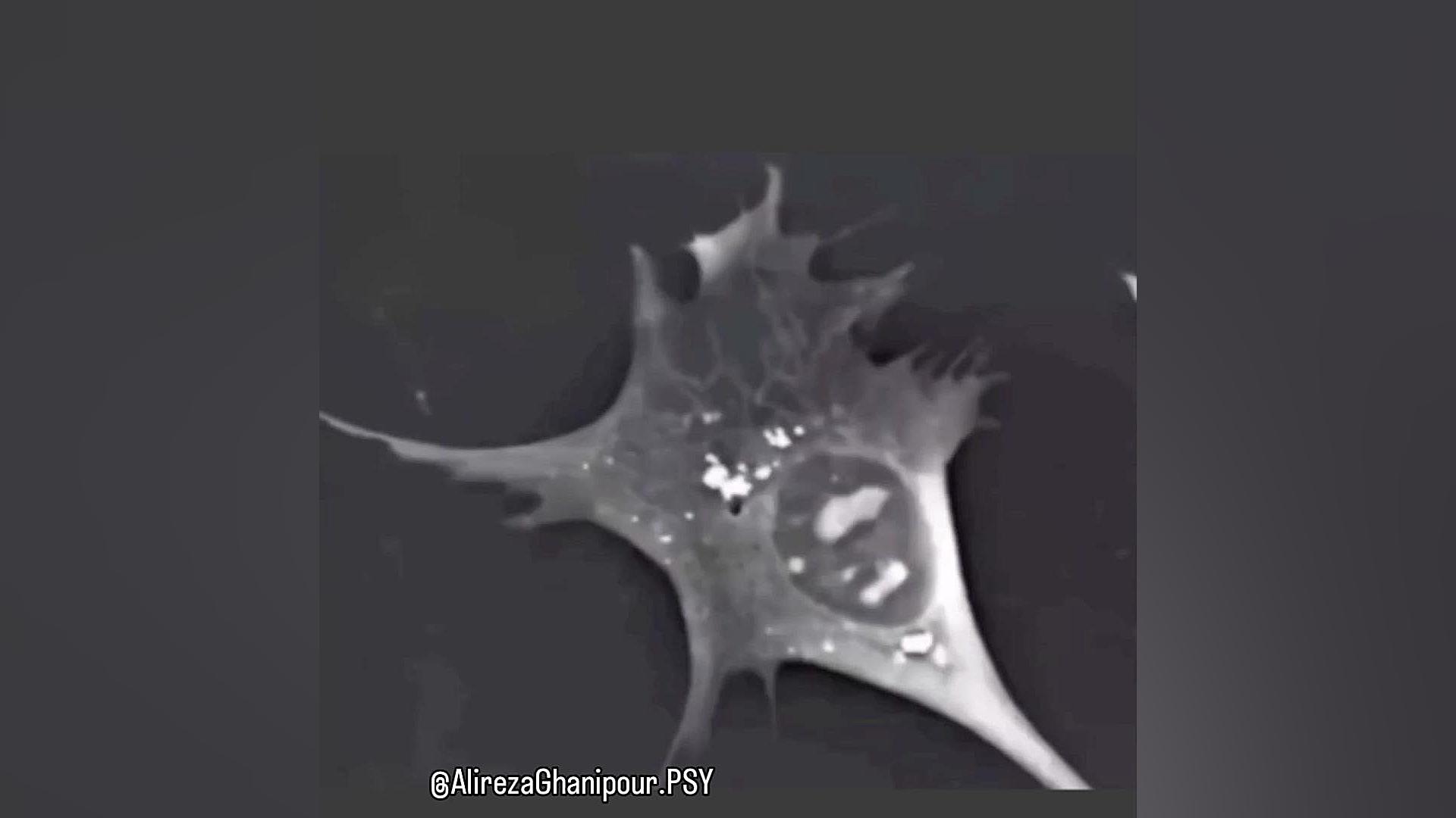 فروپاشی عصبی علامت برودزینسکی