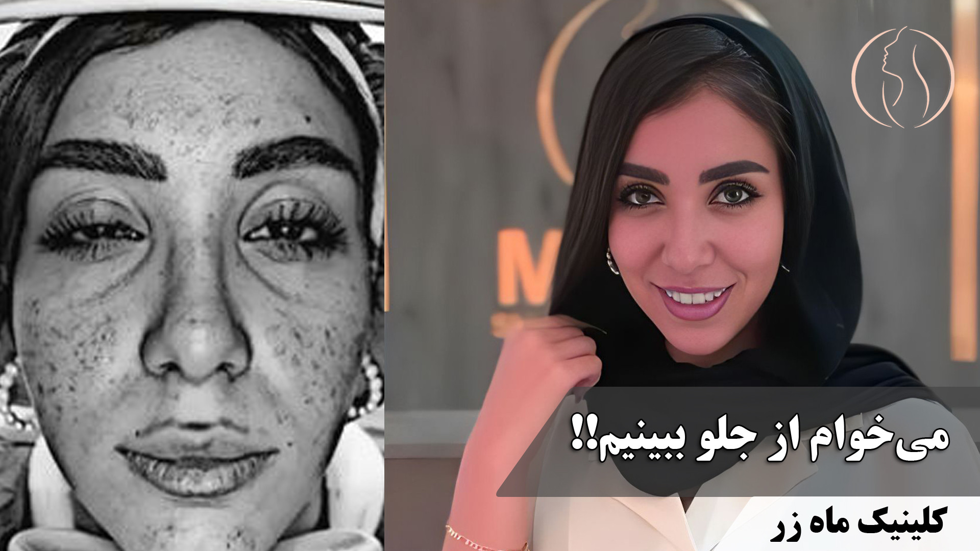 جفت شیش !!! ( کلینیک زیبایی ماه زر ) هپاتواسپلنومگالی
