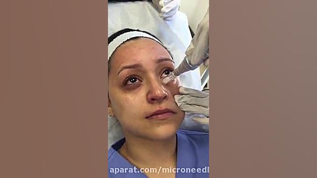 میکرونیدلینگ دورچشم کاندسارتان
