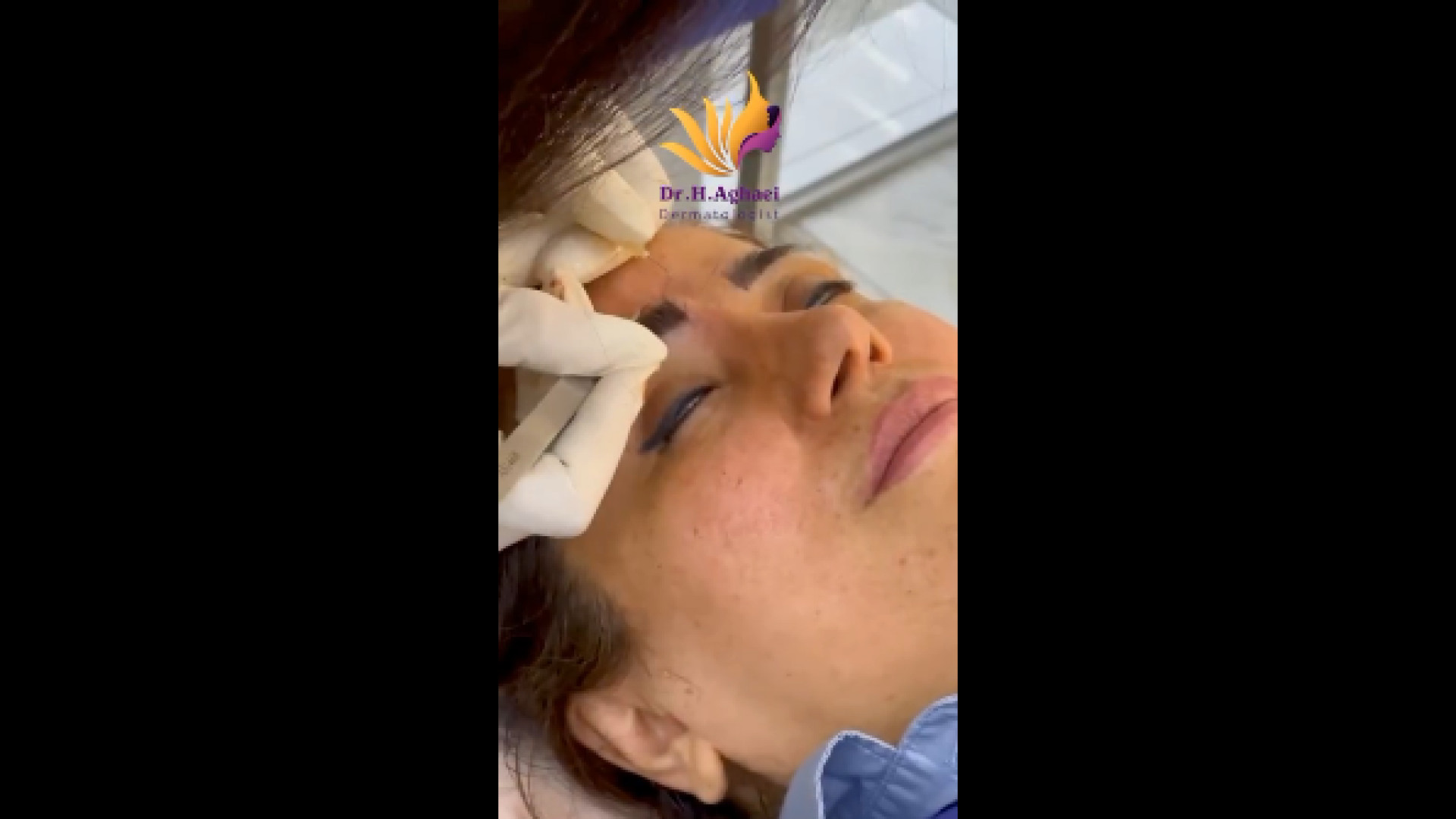 کاشت ابرو طبیعی دکتر حمیده آقایی