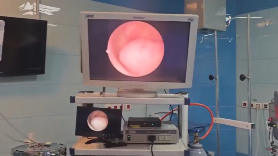 پولیپ رحمی چیست؟