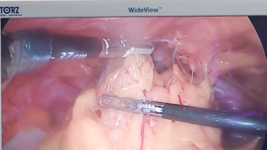 توده تخمدان