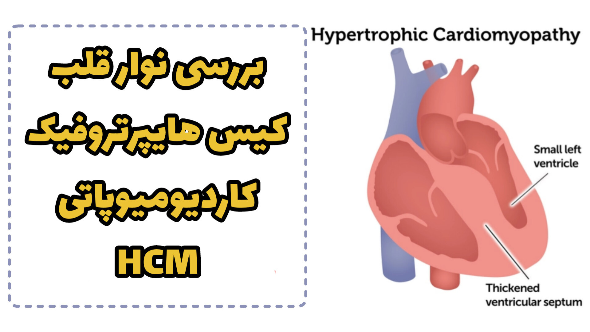 تفسیر نوار قلب کاردیومیوپاتی هایپرتروفیک Hypertrophic cardiomyopathy ECG زاویه سازی صورت