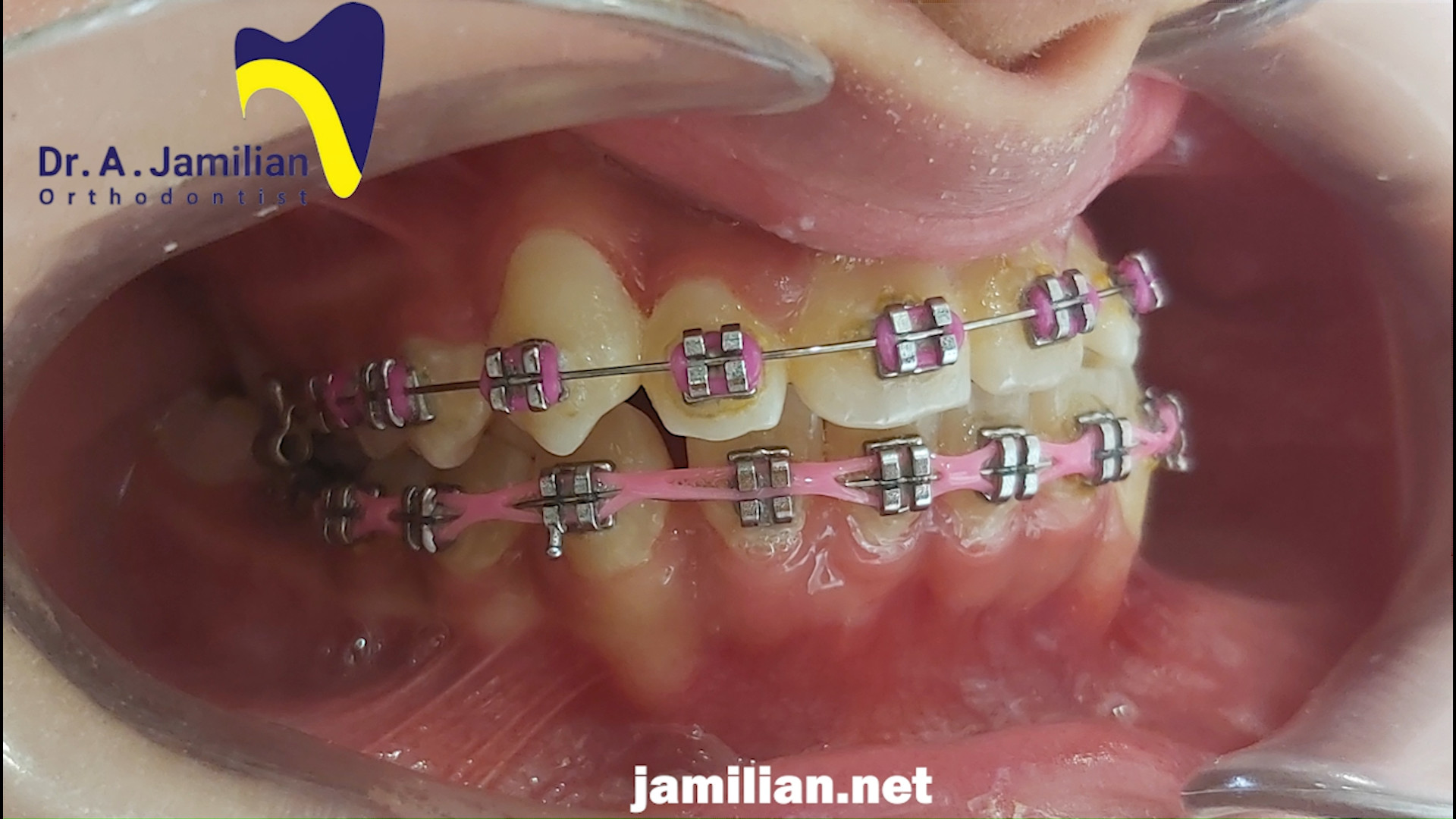 درمان مشکلات فک و دندان با ارتودنسی دندان / متخصص ارتودنسی / دکتر جمیلیان دکتر عبدالرضا جمیلیان - متخصص ارتودنسی
