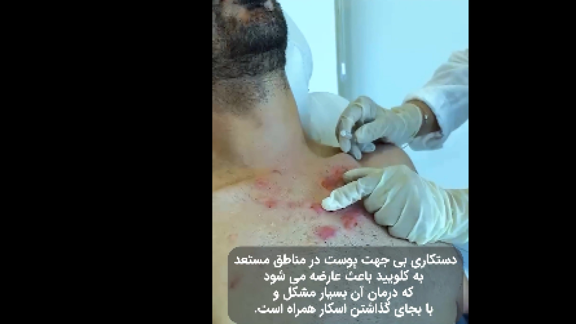 درمان کلوئید پوست دکتر پروانه ساکت - متخصص پوست و مو، زیبایی