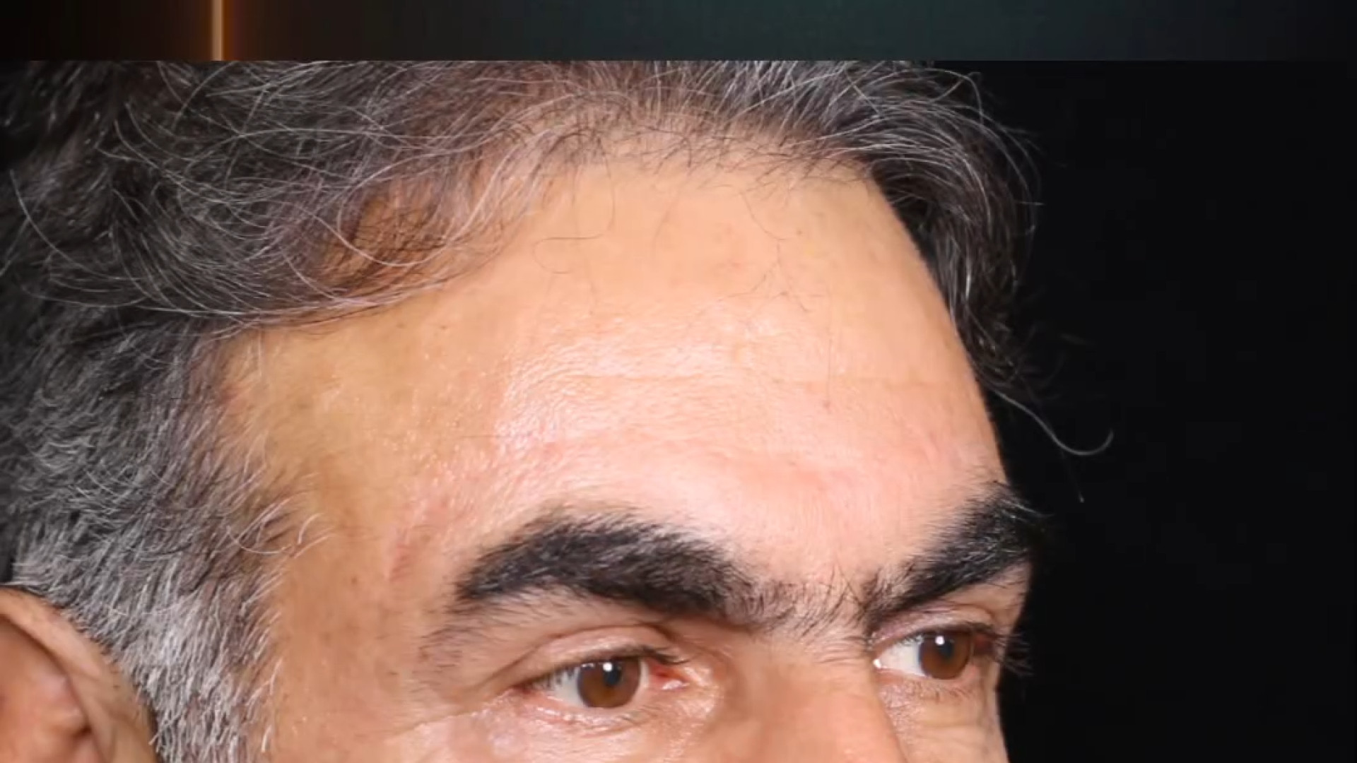 لیفت پیشانی | دکتر شهریار یحیوی بیماری کارنی تین ناقل نقص اولیه