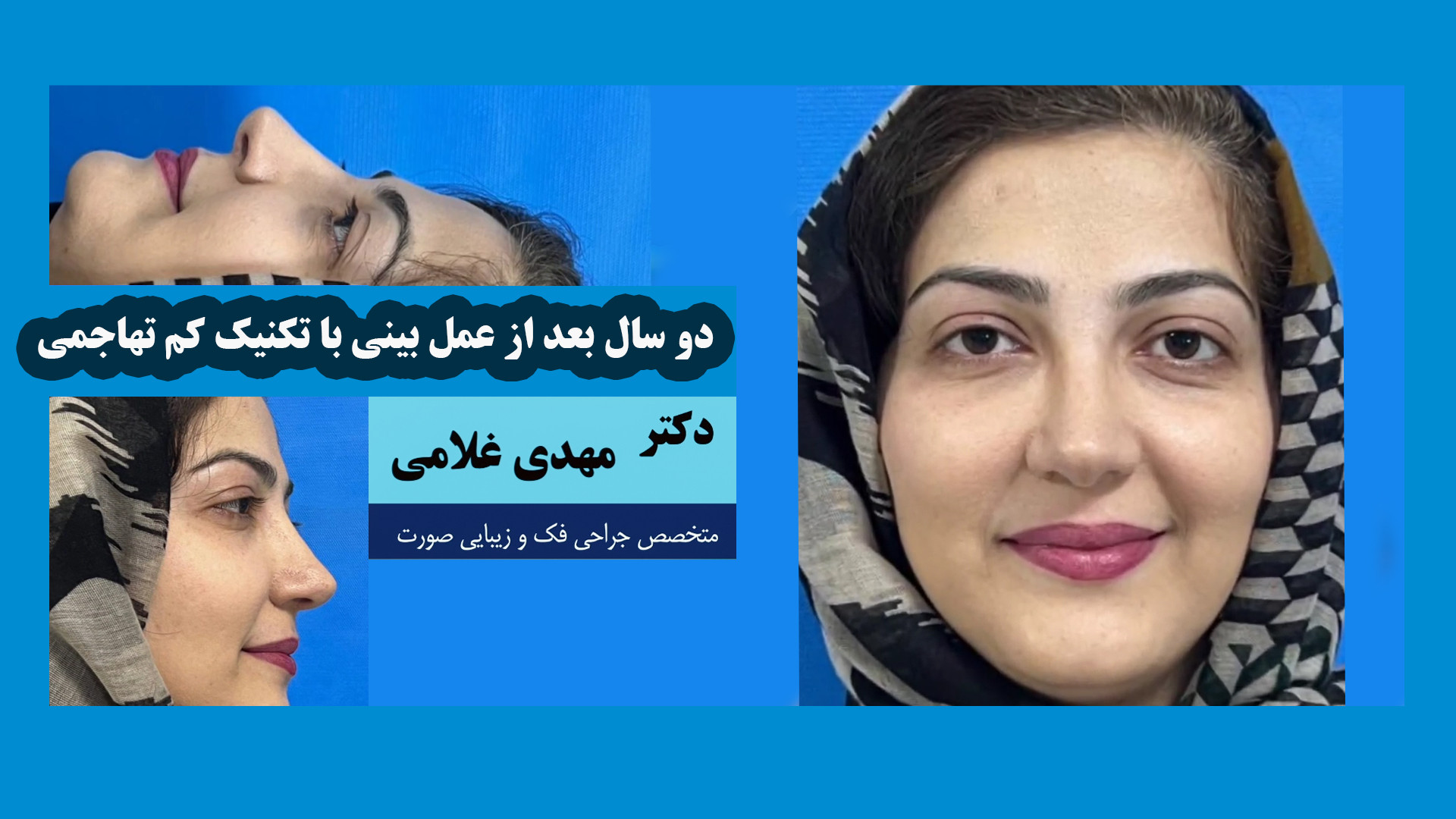 دو سال بعد از عمل بینی با تکنیک کم تهاجمی دکتر مهدی غلامی