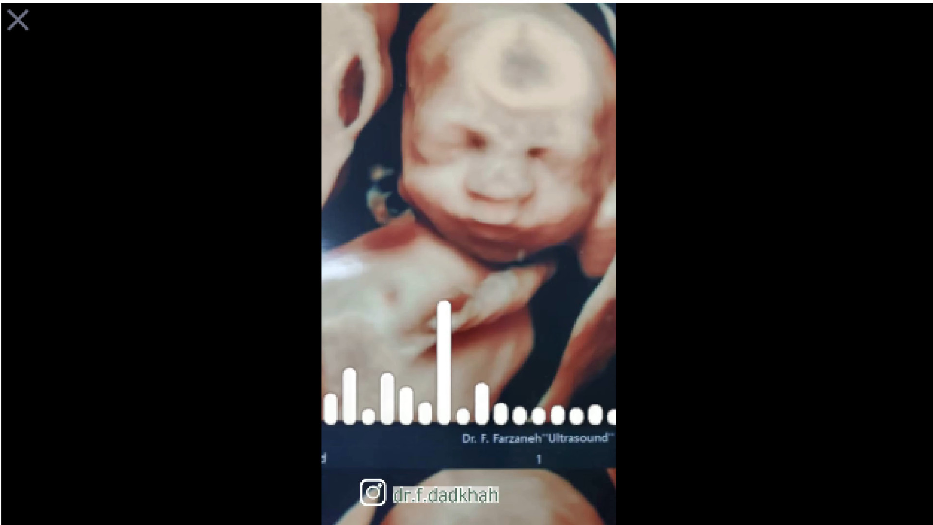 سونوگرافی سه بعدی جنین شبنم قلی‌خانی