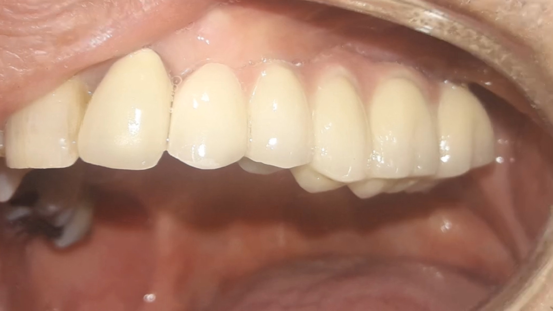 ایمپلنت طرح لبخند دکتر علی قمری - متخصص جراحی لثه و ایمپلنت