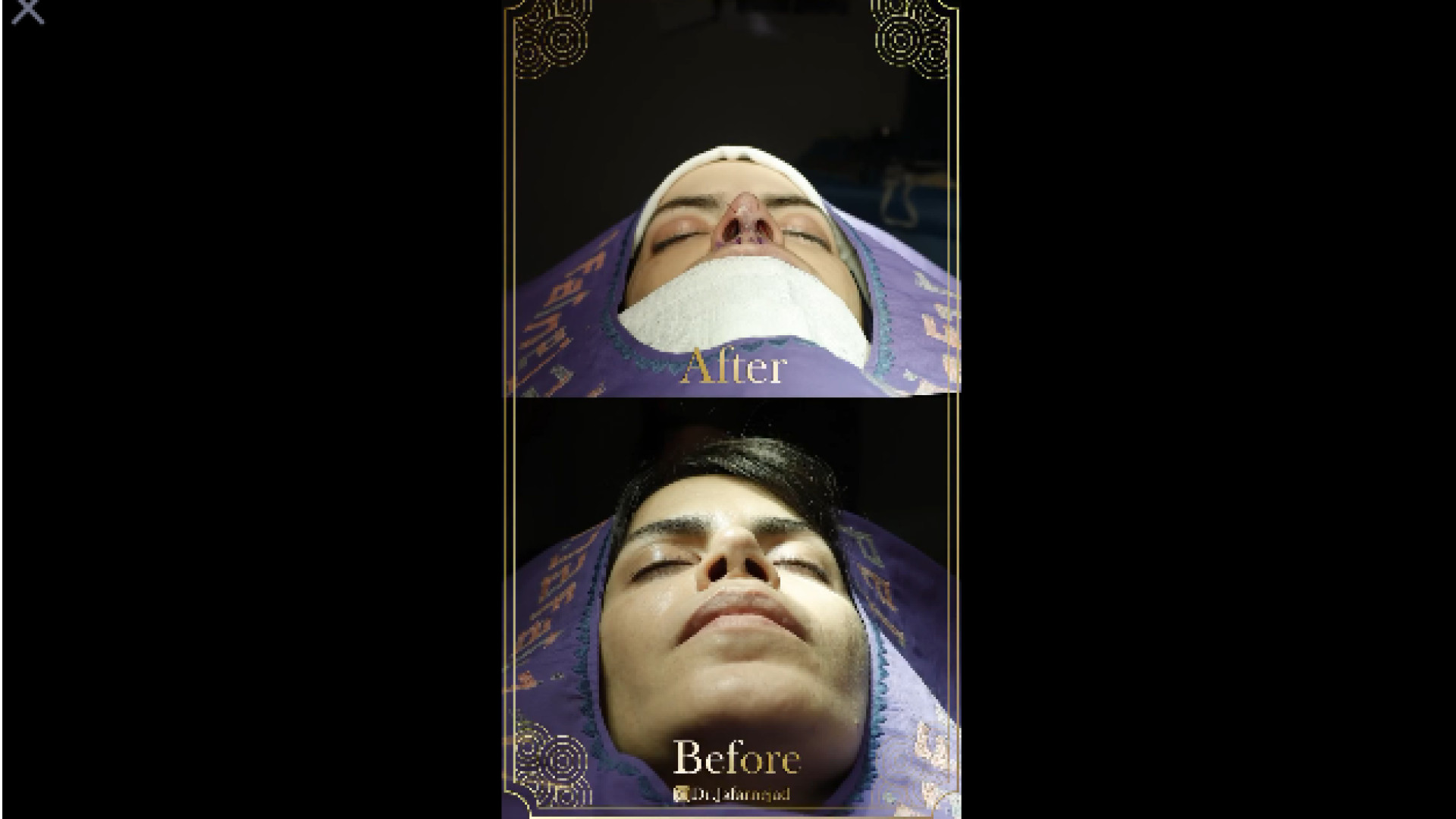 جراحی بینی ترمیمی دکتر بابک جعفرنژاد