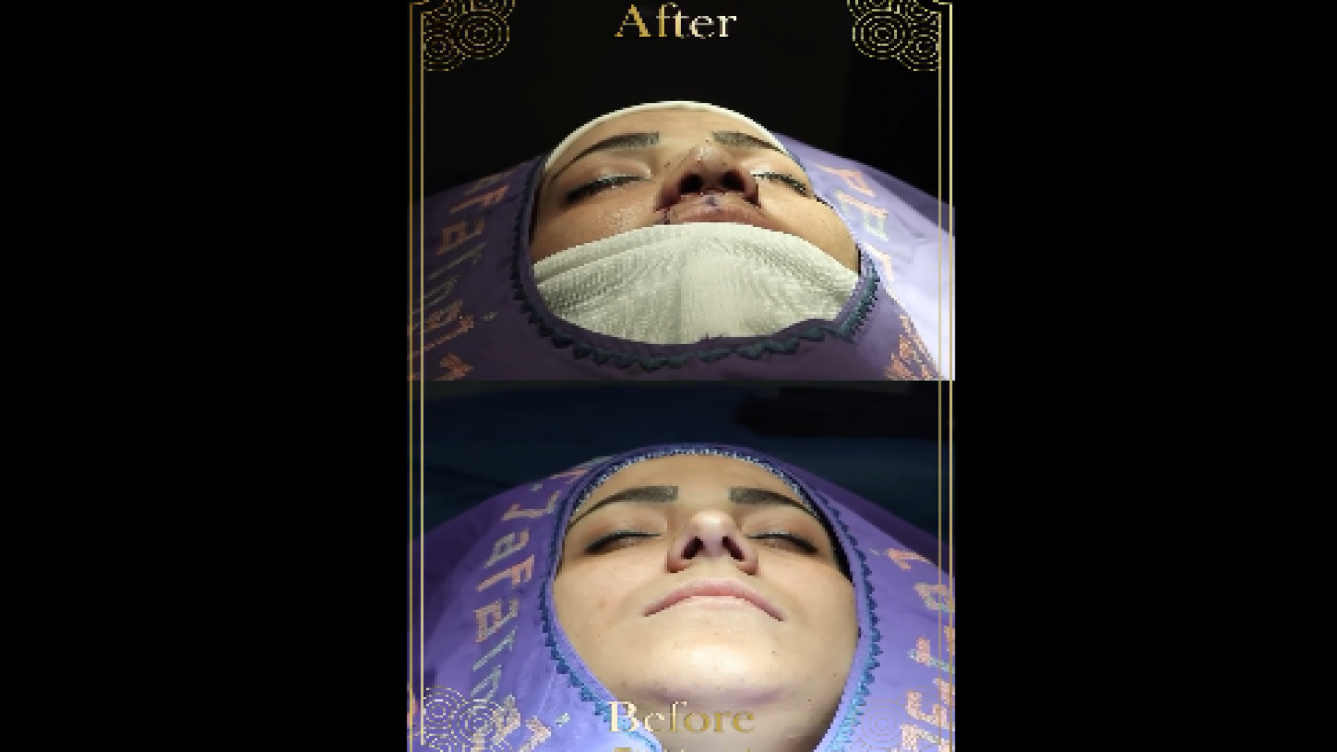 جراحی بینی قوس دار دکتر بابک جعفرنژاد