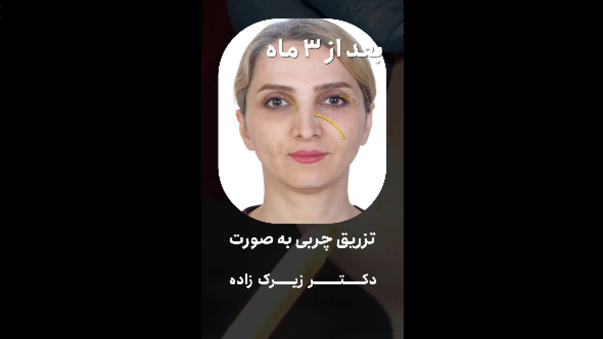 فیلم تزریق چربی به صورت دکتر هاتف زیرک زاده - فوق تخصص جراحی پلاستیک