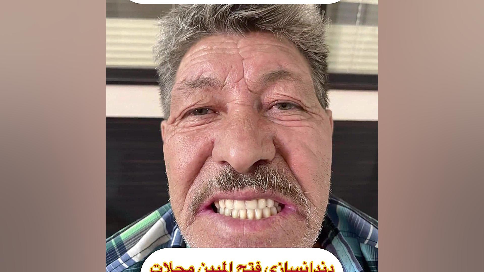 ساخت دندان مصنوعی در محلات GRO-Seq