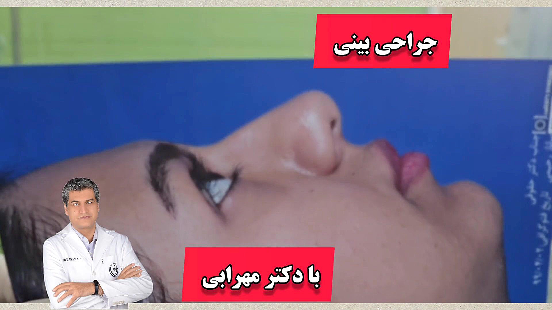عمل بینی نیمه فانتزی شیراز بینی گوشتی بینی قوزدار دکتر مهرابی دکتر محمد مهدی مهرابی جراح پلاستیک و زیبایی