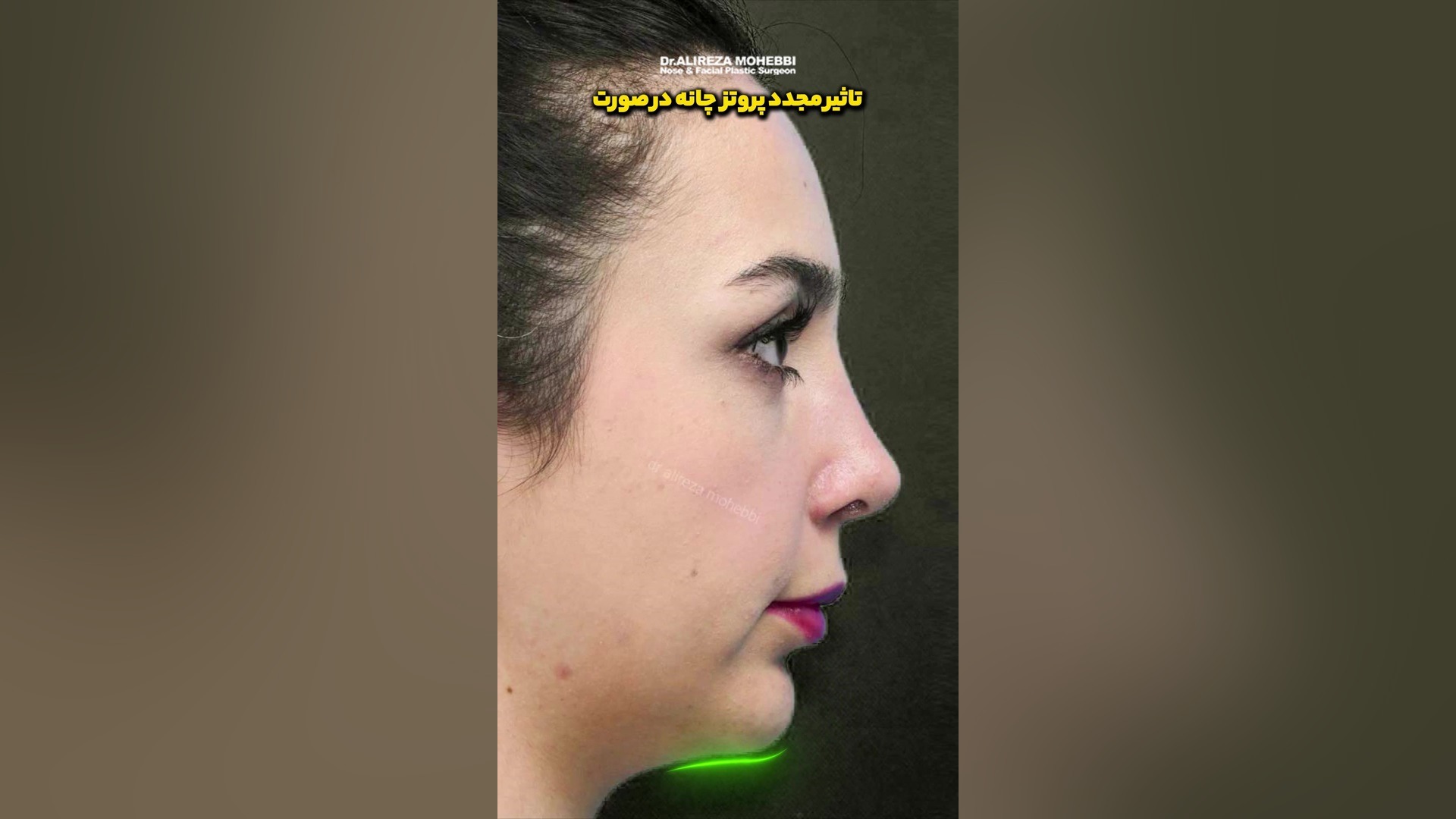 تاثیر پروتز چانه و جراحی بینی در چهره