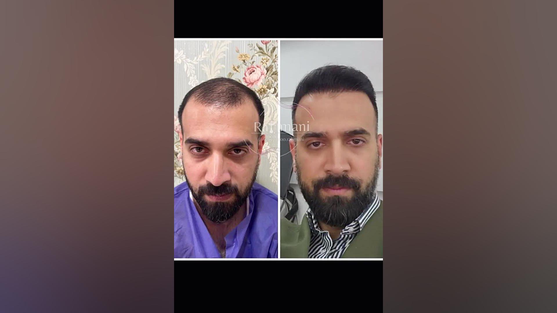 کلینیک کاشت مو رحمانی | سایت بهترین در مشهد CUT&Tag