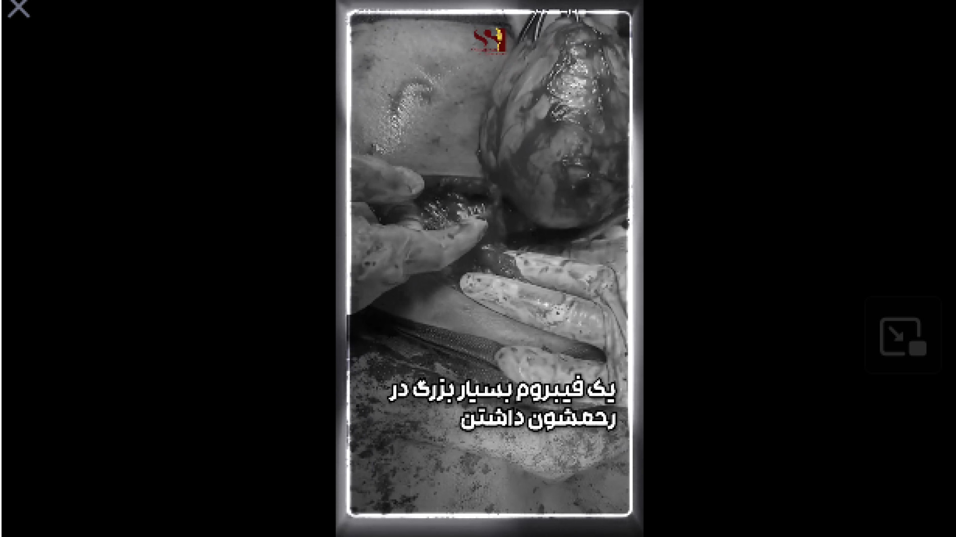 فیلم عمل فیبروم بسیار بزرگ رحمی دکتر شیرین شمس جراح و متخصص زنان و زایمان