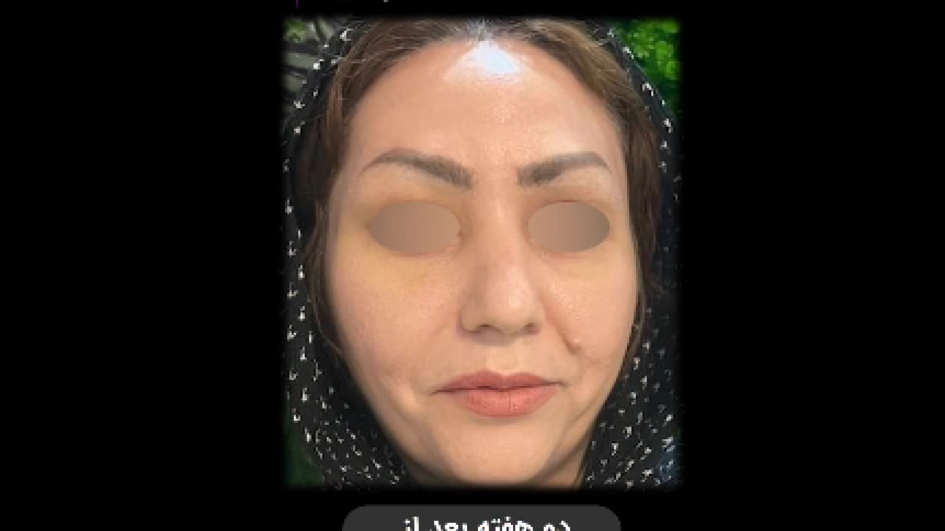 لیفت آندوسکوپی دکتر کامران بابایی
