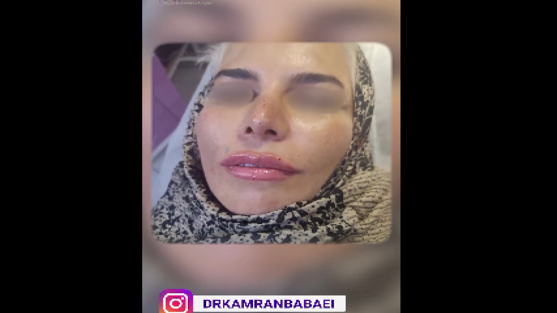 نمونه کار فیلر لب دکتر کامران بابایی