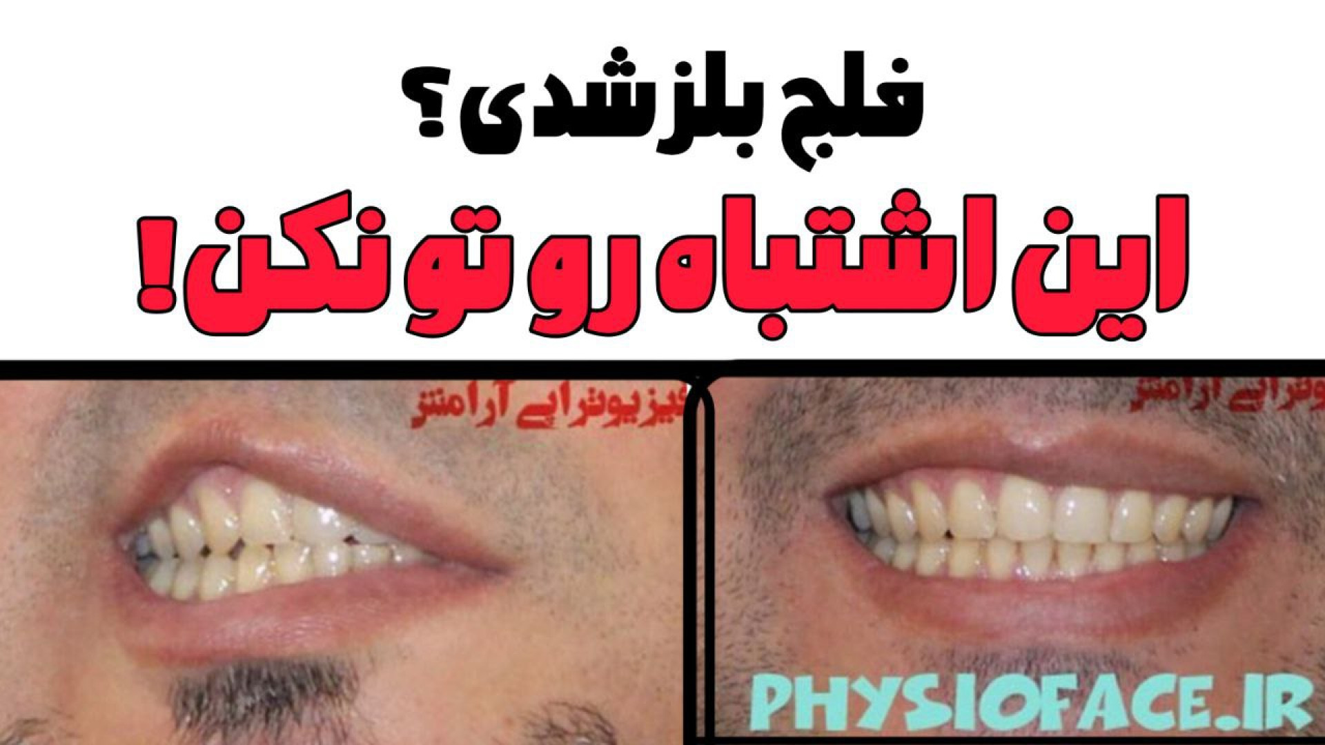 فلج بلز شدی؟ این اشتباه رو تو نکن! برداشتن زگیل