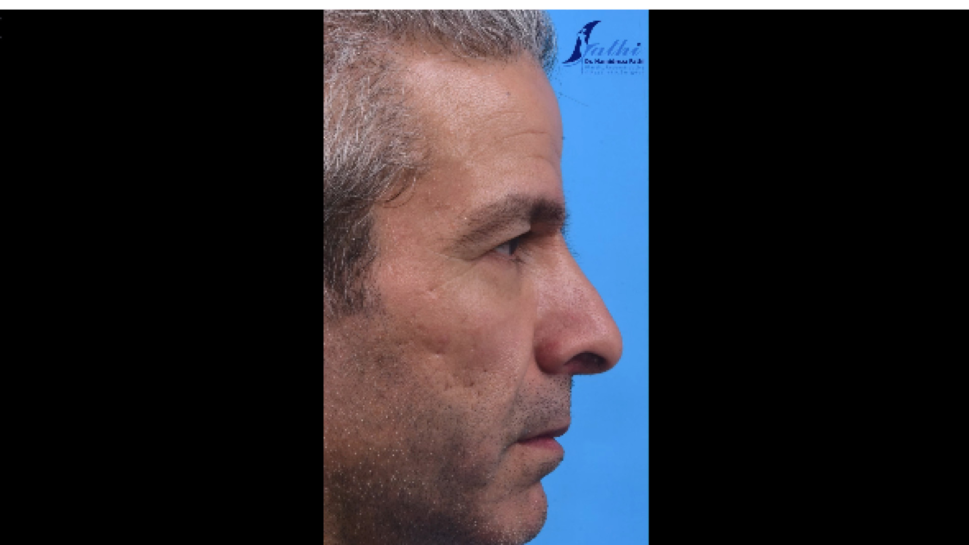 لیفت اندوسکوپی، لیفت گردن وصورت PVRژنتیک پزشکی پیشرفته