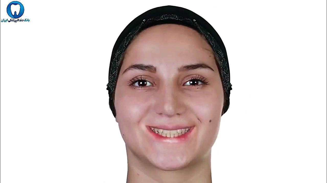 ارتودنسی دندان نیش بیرون زده بیولوژی پرتوی