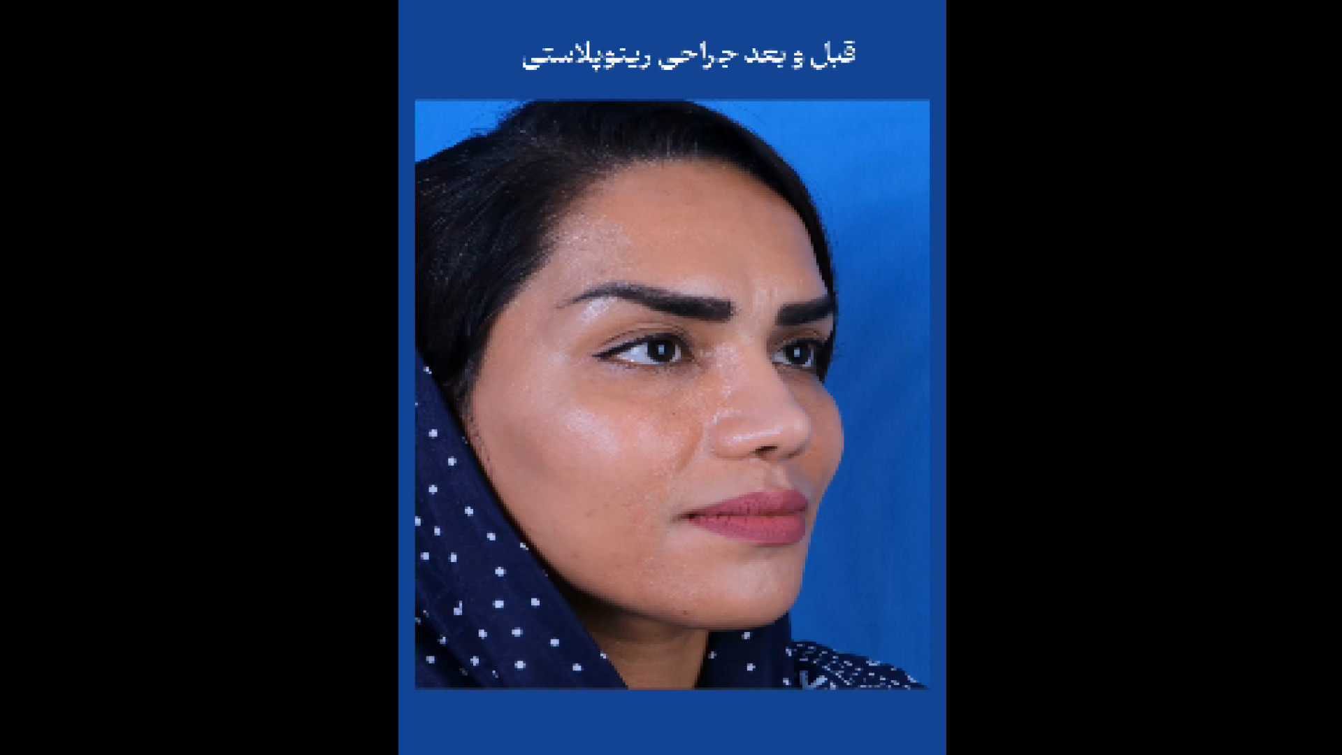 قبل و بعد عمل بینی دکتر فردوس مذنبی