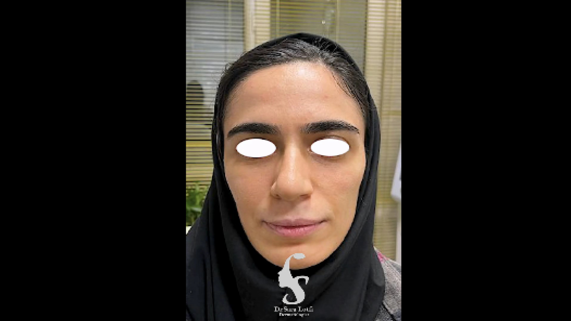 تزریق فیلر و اصلاح فرم صورت دکتر سار ا لطفی