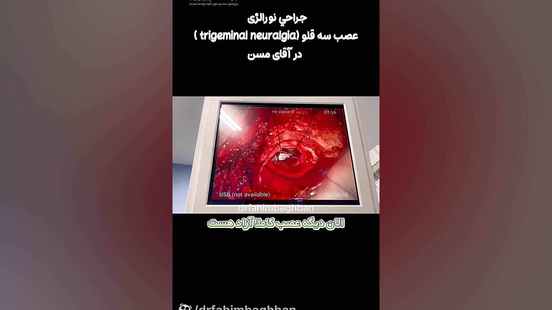 جراحی نورالژی عصب سه قلو ( trigeminal neuralgia ) در آقای مسن مینی سریال