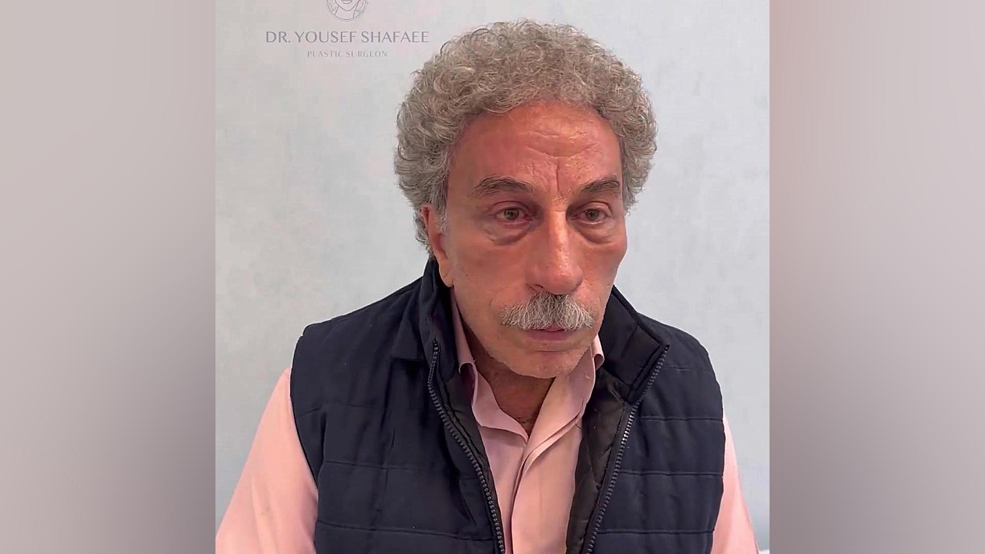 فیلم لیفت صورت با جدیدترین روش جراحی دکتر یوسف شفائی فوق تخصص جراحی پلاستیک و ترمیمی