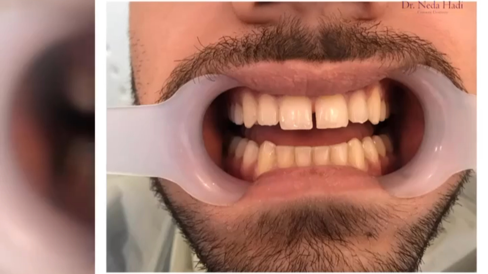 نمونه کار اصلاح طرح لبخند دکتر ندا هادی-دندانپزشک زیبایی