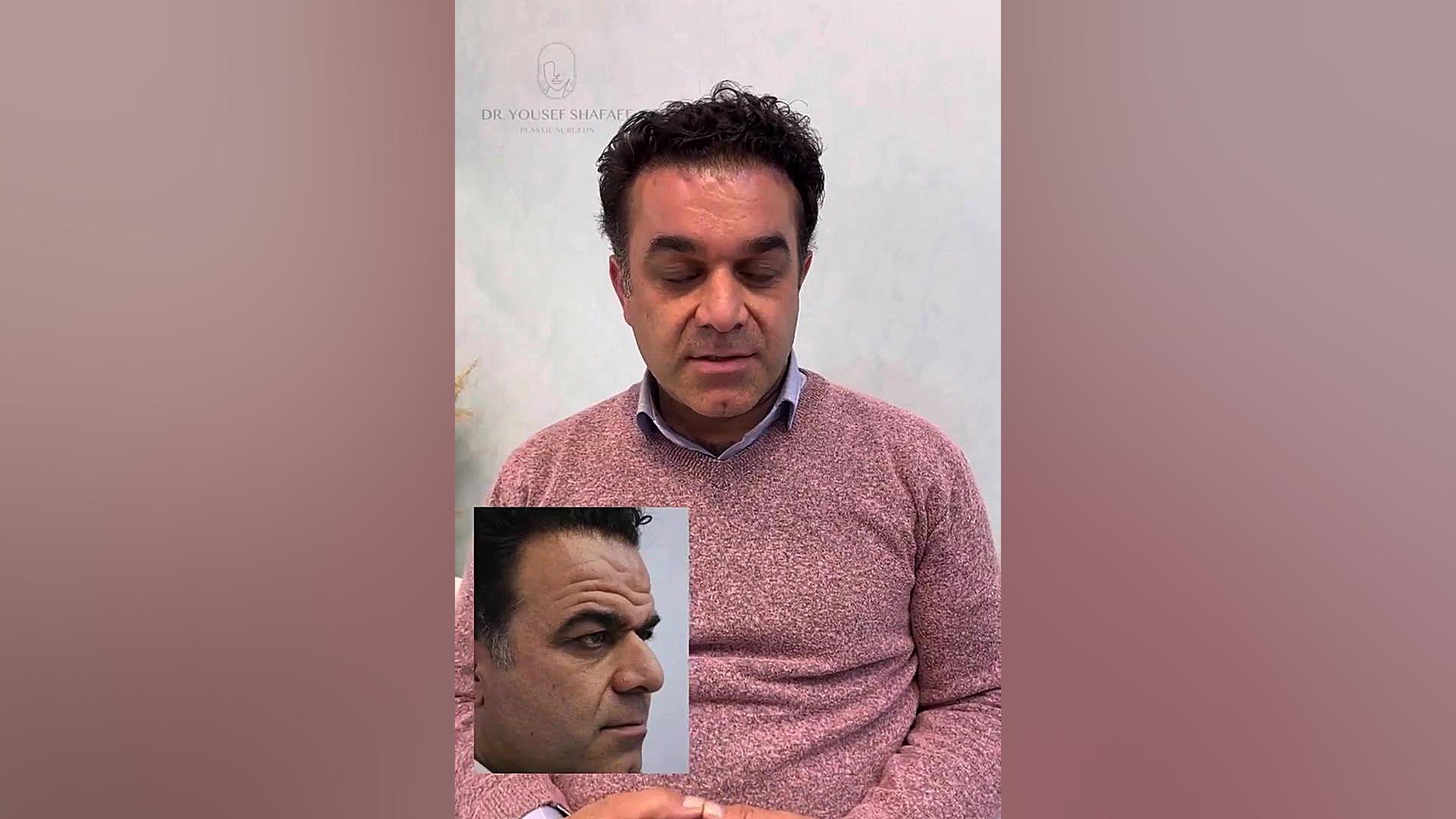 قبل و بعد عمل لیفت صورت دکتر یوسف شفائی فوق تخصص جراحی پلاستیک و ترمیمی