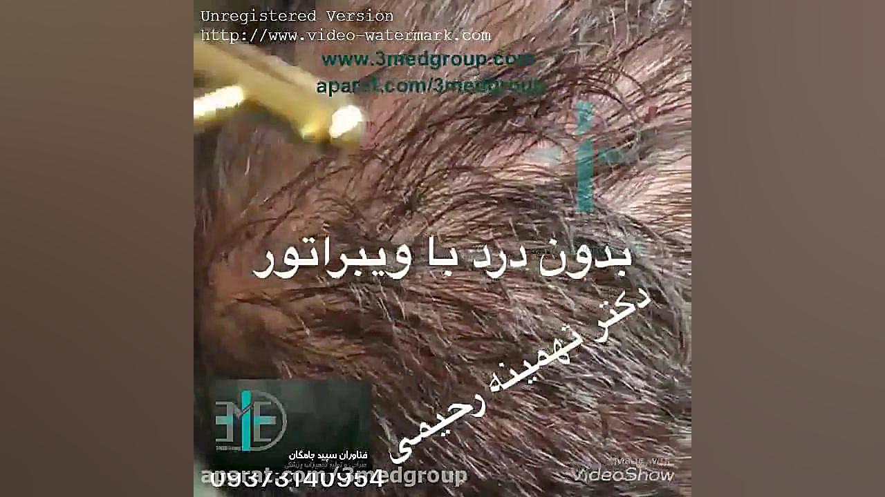 درمان ریزش مو با دستگاه پزشکی Carboxy Therapy مایکروگناتیا