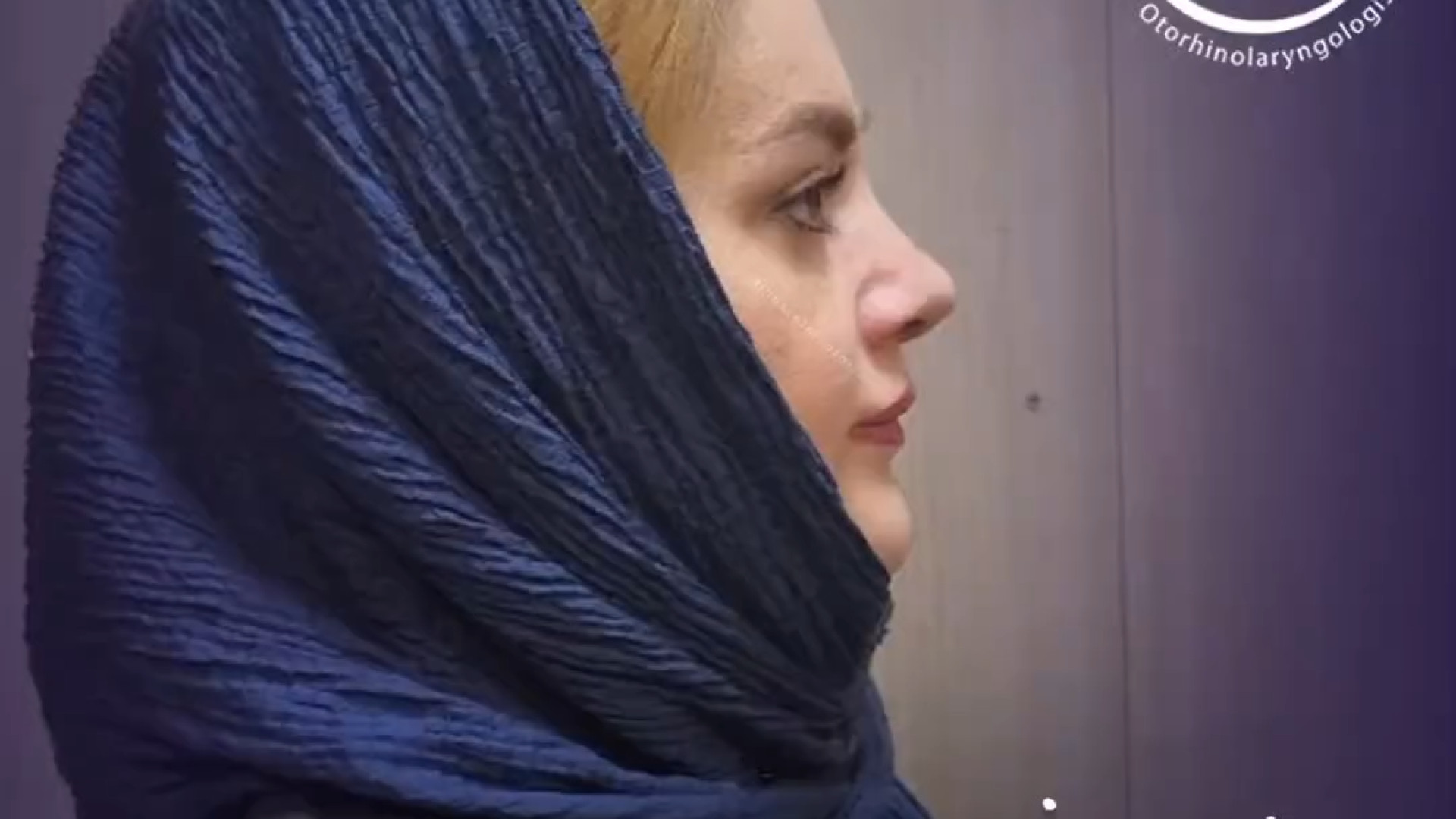 جراحی بینی گوشتی | دکتر علی واجاری دکتر علی حسینی واجاری - جراح بینی رشت