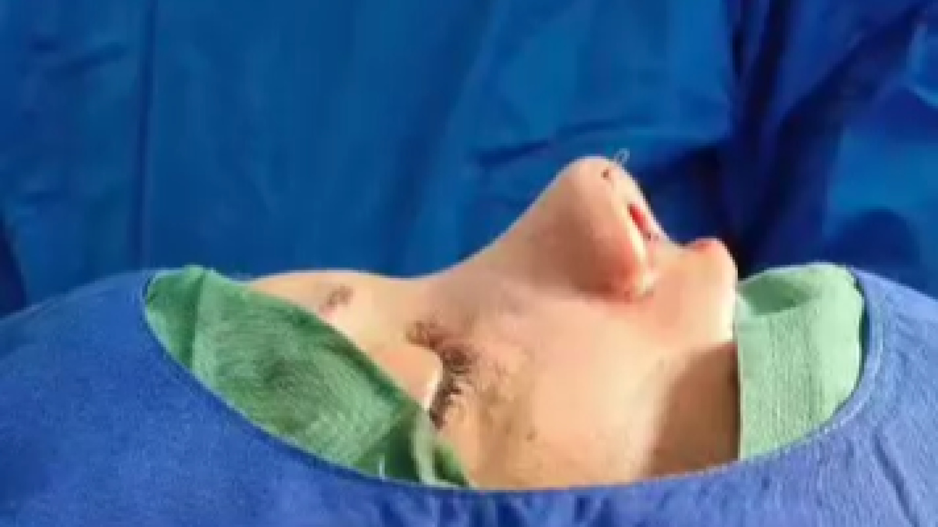 جراحی بینی قوزدار | دکتر علی واجاری دکتر علی حسینی واجاری - جراح بینی رشت