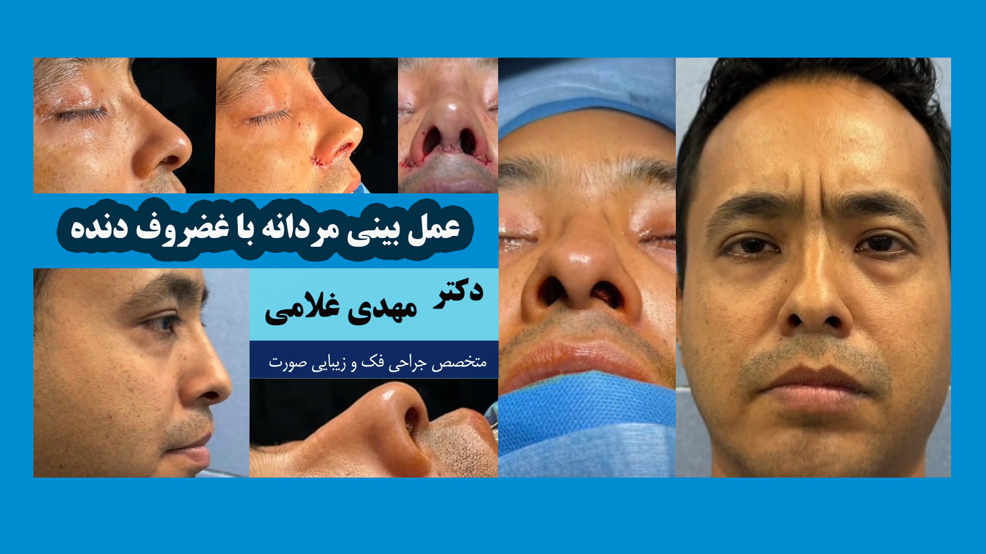 عمل بینی مردانه با غضروف دنده دکتر مهدی غلامی