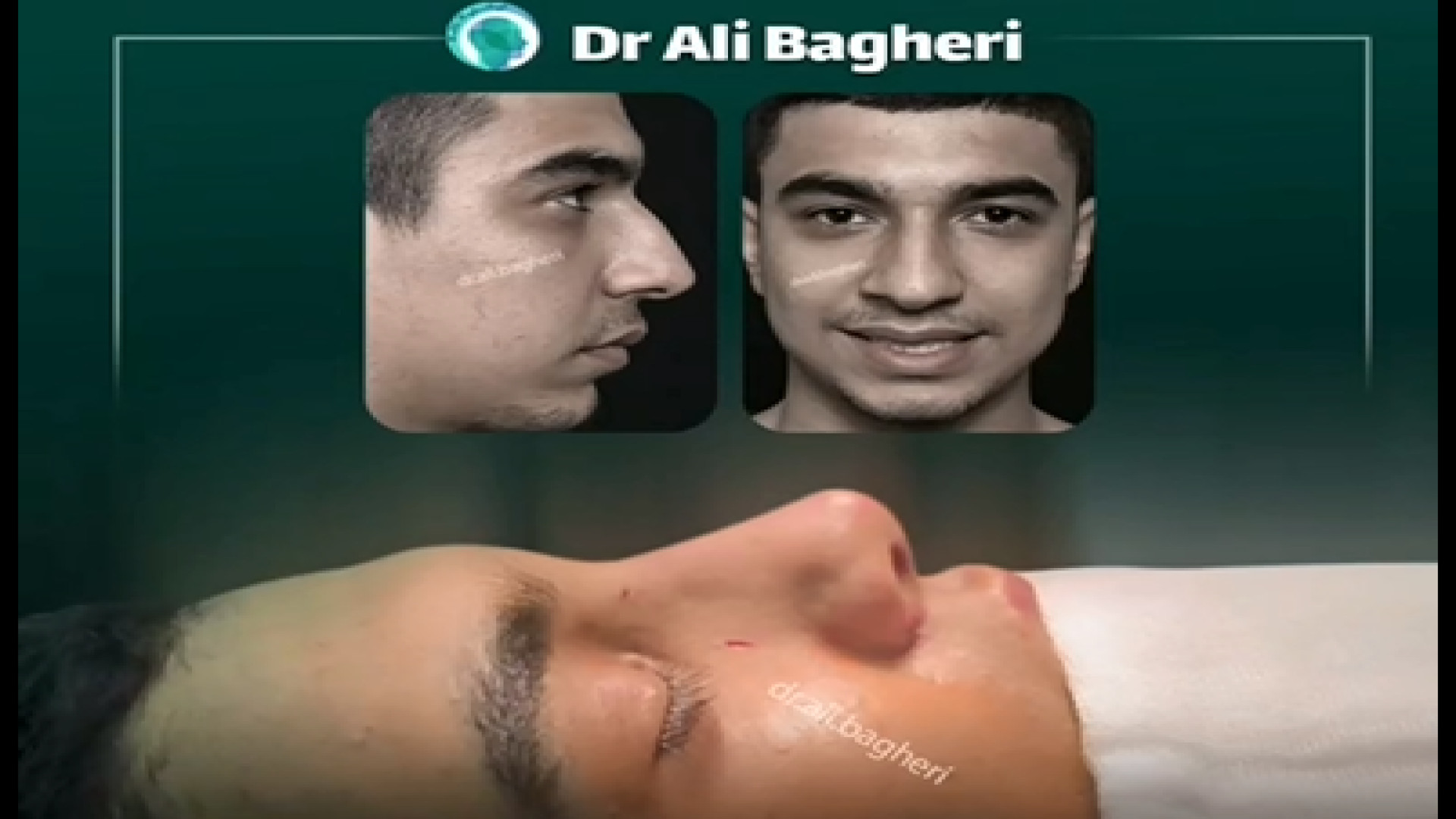 جراحی زیبایی بینی مردانه _ دکتر علی باقری حق دکتر علی باقری حق